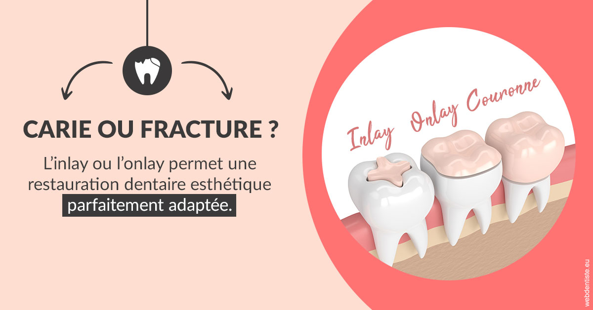https://www.simon-orthodontiste.fr/T2 2023 - Carie ou fracture 2