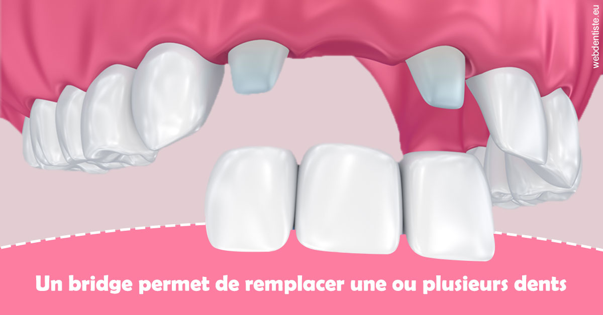 https://www.simon-orthodontiste.fr/Bridge remplacer dents 2