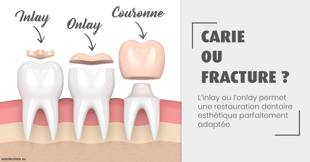 https://www.simon-orthodontiste.fr/T2 2023 - Carie ou fracture 1