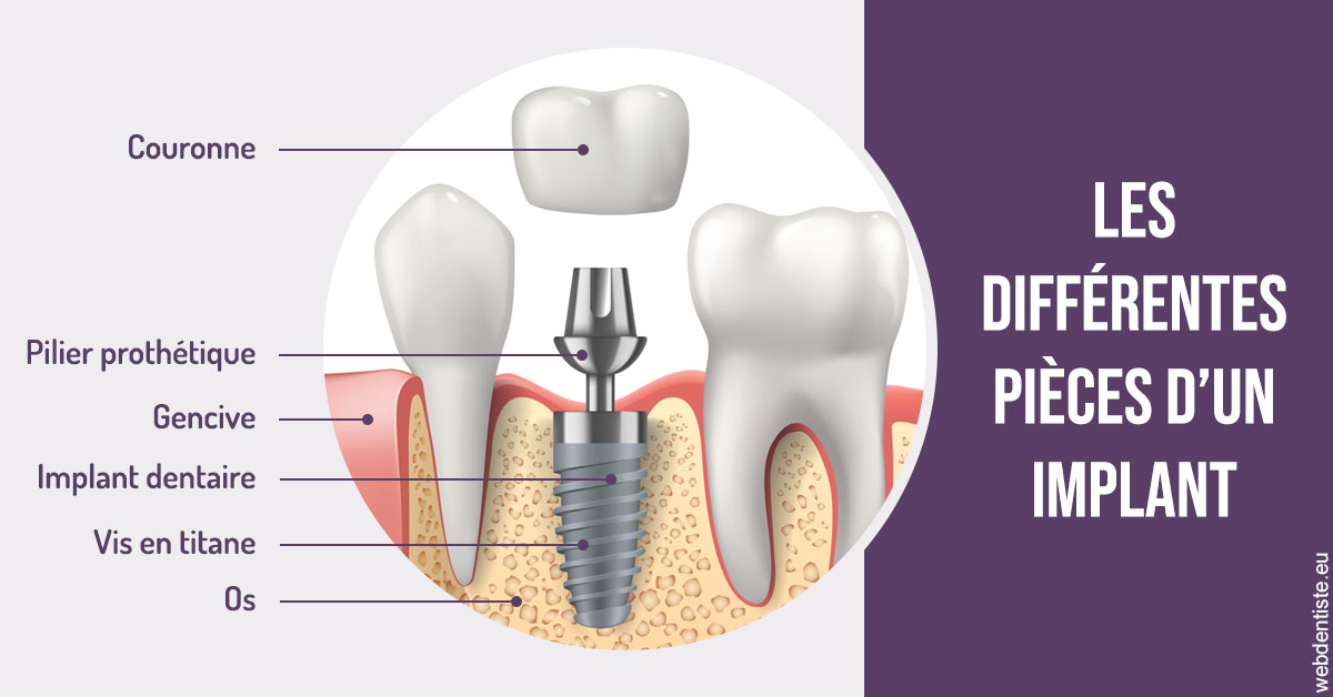 https://www.simon-orthodontiste.fr/Les différentes pièces d’un implant 2