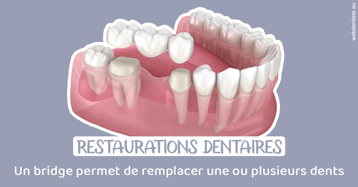 https://www.simon-orthodontiste.fr/Bridge remplacer dents 1