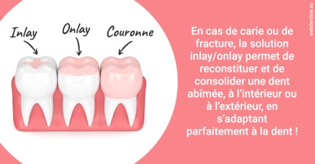 https://www.simon-orthodontiste.fr/L'INLAY ou l'ONLAY 2