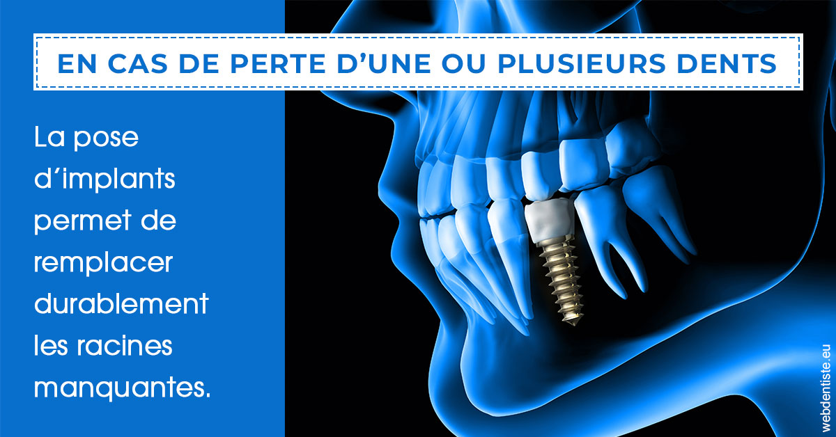 https://www.simon-orthodontiste.fr/2024 T1 - Implants 01