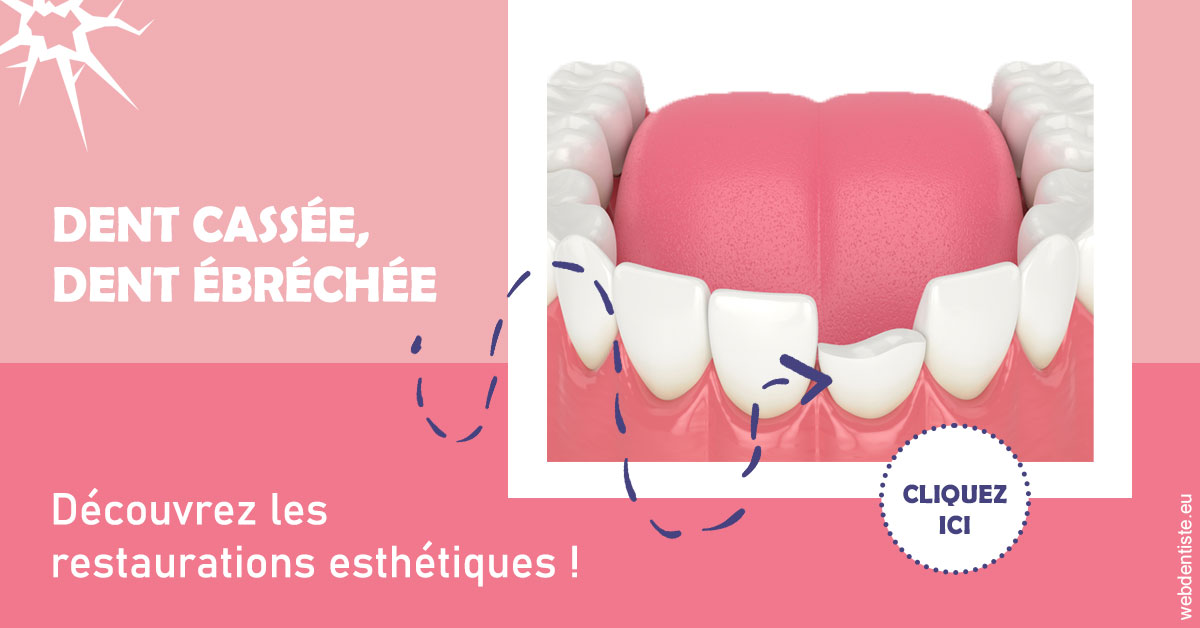 https://www.simon-orthodontiste.fr/Dent cassée ébréchée 1