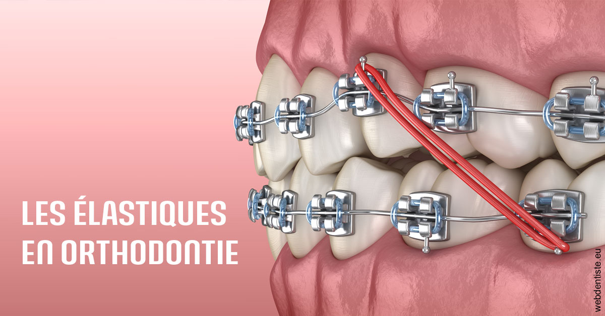 https://www.simon-orthodontiste.fr/Elastiques orthodontie 2