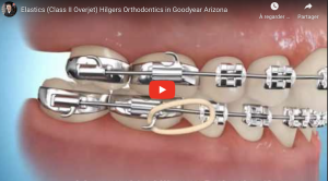 Elastics (Class II Overjet) Hilgers Orthodontics in Goodyear Arizona